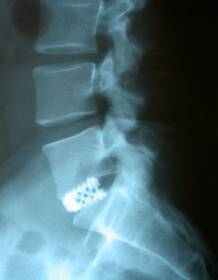 Postoperative Röntgenkontrolle