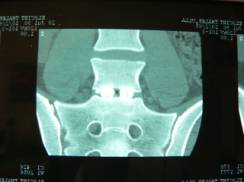 Schichtaufnahme nach Operation